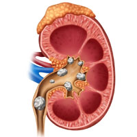 درمان سنگ کلیه