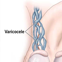 جراحی واريکوسل